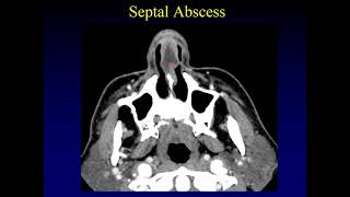 Imaging of the Paranasal Sinuses 3 [upl. by Mead]