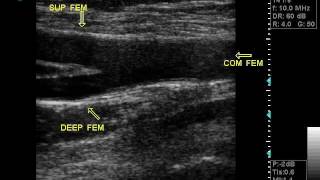 DOPPLER VASCULAR ULTRASOUND OPTIMAL VIEW OF COMMON ARTERYS BIFwmv [upl. by Einotna349]