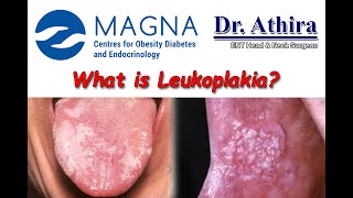 What is Leukoplakia [upl. by Vashti]