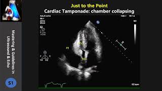 cardiac tamponadecollapsing chamber [upl. by Akenna447]