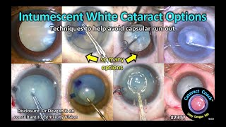 CataractCoach™ 2377 options for intumescent white cataracts [upl. by Matt]