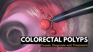 Colorectal Polyps Causes Signs and Symptoms Diagnosis and Treatment [upl. by Euqinahs]