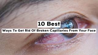 10 Best Ways To Get Rid Of Broken Capillaries From Your Face [upl. by Ramirol]