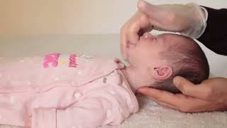 HOW WE FIXED INFANT TONGUE TIE and MOUTH MUSCLE CONTRACTURES causing BREASFEEDING PROBLEMS [upl. by Ahsrats]