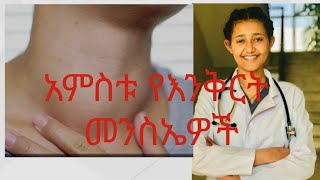 እንቅርትGoiter እንቅርት goiter habesha Ethiopia doctor medicaleducation [upl. by Parshall113]