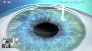 LASIK vs SMILE  Femto LenSx [upl. by Larrad]