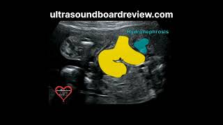 Hydronephrosis Fetal Ultrasound [upl. by Roselia]