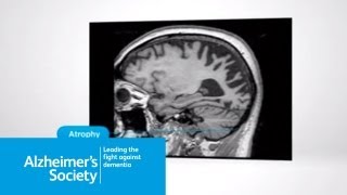 What is posterior cortical atrophy [upl. by Aseram555]