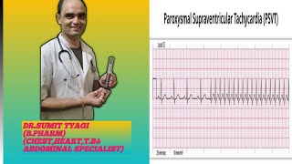 PAROXYMAL SUPERVENTRICULAR TRACHYCARDIA BY DRSUMIT TYAGISUMITMEDICALDISPENSARY1 [upl. by Koal]