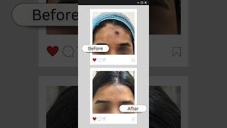 Face Lesion  Face Mark treatment drshalupunj result plasticsurgery [upl. by Catton]