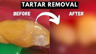 Huge TARTAR REMOVAL From Teeth  TEETH CLEANING [upl. by Oballa880]