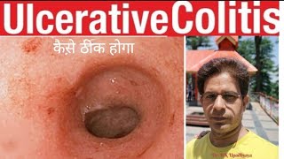 क्या ULCERATIVE COLITIS जड़ से ख़त्म होगी  ASK THE EXPERT CAN YOU CURE ULCERATIVE COLITIS colitis [upl. by Aramoy]