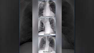 Chest Xrays describing Pathalogies 🩻 medical xray radiology infection disease shorts [upl. by Anitirhc]