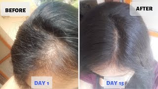 OMG  15 Days Hair Growth Miracle Treatment  Grow Long Thicken Hair  100 works [upl. by Gerrilee57]