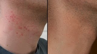 HOW TO CURE RAZOR BURN BUMPS ON NECK amp LEGS [upl. by Tolmach844]