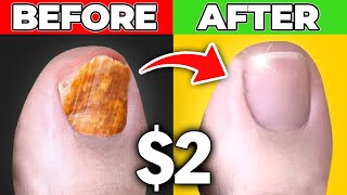 Get Rid Of Toenail Fungus for Good for Only 200 [upl. by Faxen]