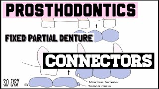 CONNECTORS II RIGID AND NON RIGID II FIXED PARTIAL DENTURE II PROSTHODONTICS [upl. by Llezo216]