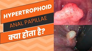 Anal Papillae क्या होता हैhypertrophoid papillae fissure chronic piles symptoms fistula [upl. by Asserak]