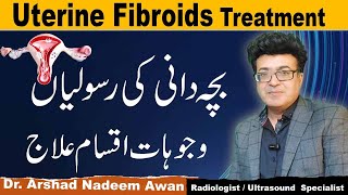 Uterine Fibroids CausesTypesSymptoms And Treatment [upl. by Hoj]