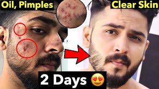 10 Pimple Mistakes  How to Remove Pimples From Face  Remove Acne Naturally [upl. by Naginarb]