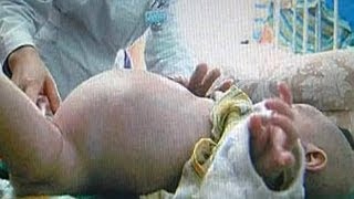 Pregnant TwoYearOld Boy Gives Birth To Unborn Twin [upl. by Eisus223]