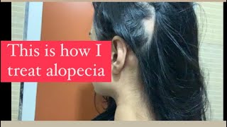 Treat alopecia at home baldness rosemary affordable alopecia hairgrowth [upl. by Anead]