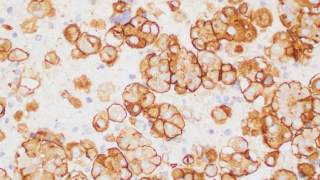 Mesothelioma cytology IHC cell block [upl. by Dlaniger]