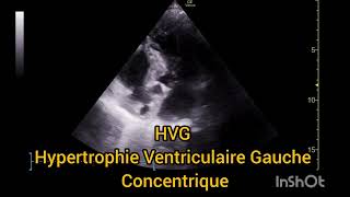 HVG Hypertrophie Ventriculaire Gauche Concentrique Échographie [upl. by Adnelg]