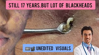 Blackheads extraction in a young male  blackheads blackheadremoval DrAMAZINGSKIN [upl. by Pachton]