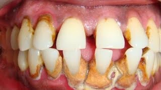 Teeth whitening  Gum bleeding  Yellow teeth stain cleaning  दांत सफेद करना  मसूड़ों से खून बहना [upl. by Omrellig]