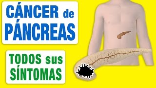 Todos los Síntomas del Cáncer de Páncreas [upl. by Daveta644]