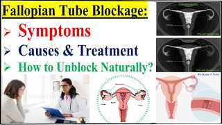 Fallopian Tube Blockage Symptoms Causes Diagnosis amp TreatmentHow To Open Blocked Fallopian Tubes [upl. by Dayle]