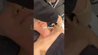 Post laser skin treatment routine for fast recovery clinique CliniquePartner Skincare [upl. by Pernas63]