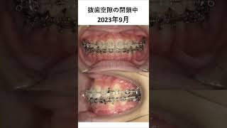 前歯のデコボコの歯列矯正・矯正歯科 歯医者 dentist  美容 [upl. by Leirad330]