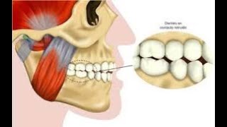 Rechinido dental [upl. by Ilyssa225]