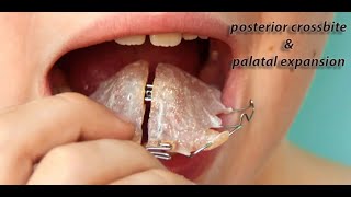 posterior crossbite and Maxillary expansion [upl. by Naelopan373]