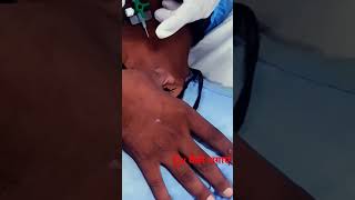 external jugular vein cannulation technique [upl. by Zingale]