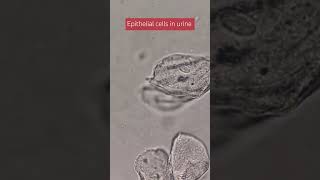 epithelial cells in urine [upl. by Malanie]