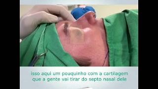 Rinoplastia Perfeita ANTES e DEPOIS  Cirurgia [upl. by Ellebanna]