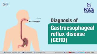 Diagnosis of Gastroesophageal Reflux Disease GERD Dr Phani Krishna Ravula [upl. by Erimahs]