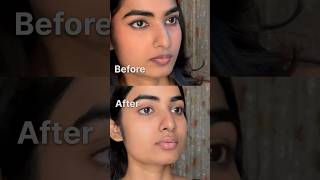 LIP HYPERPIGMENTATION Peeling off  Removal journey [upl. by Nap]