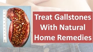 How to Treat Gallbladder Stones with Natural Remedies  Cure gallbladder stone [upl. by Neraj774]