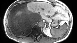 Dedifferentiated Retroperitoneal Liposarcoma [upl. by Auqeenwahs]