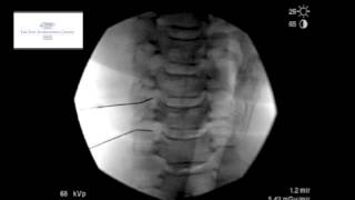 Cervical Transforaminal Epidural Sterioid Injection [upl. by Seymour]