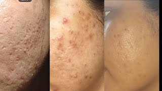 My tretinoin journey before after photos with results [upl. by Moskow]