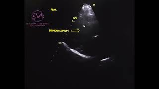 Echocardiography Sigmoid septum [upl. by Assilana]