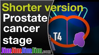 Prostate cancer stage in advanced prostate cancer [upl. by Arinaj]