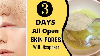 3 Days and All Open Pores Will Disappear from Your Skin Forever [upl. by Ennoitna959]