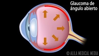 Glaucoma de Ángulo Abierto y de Ángulo Cerrado Animación Alila Medical Media Español [upl. by Neu]