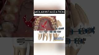 MINIMPLANT SUPPORTED MOLAR DISTALIZATION  ORTHODONTIC TIPS Shorts [upl. by Lindo]